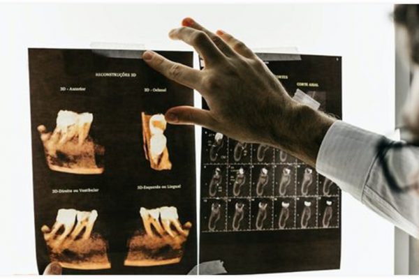 Tooth Extractions2