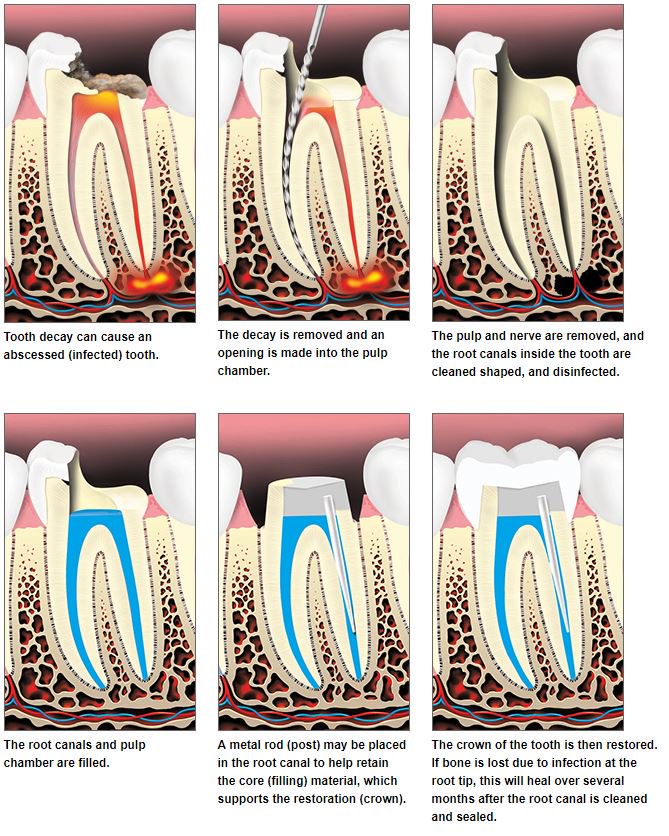 root canal 1